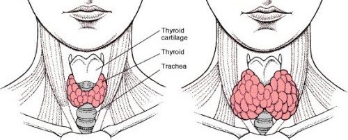 Loss Weigth After Thyroidectomy