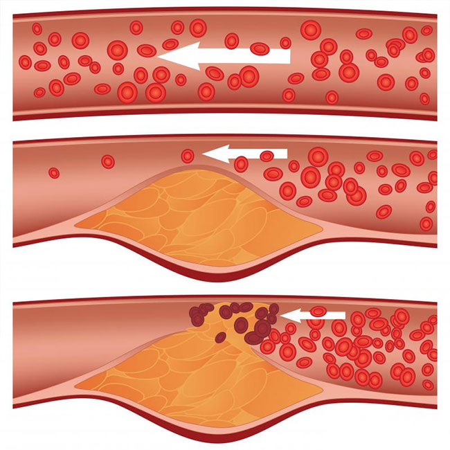 How To Remove Calcium Deposits And Plaque Buildup From Your Arteries