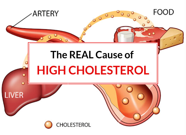 The REAL Cause of High Cholesterol