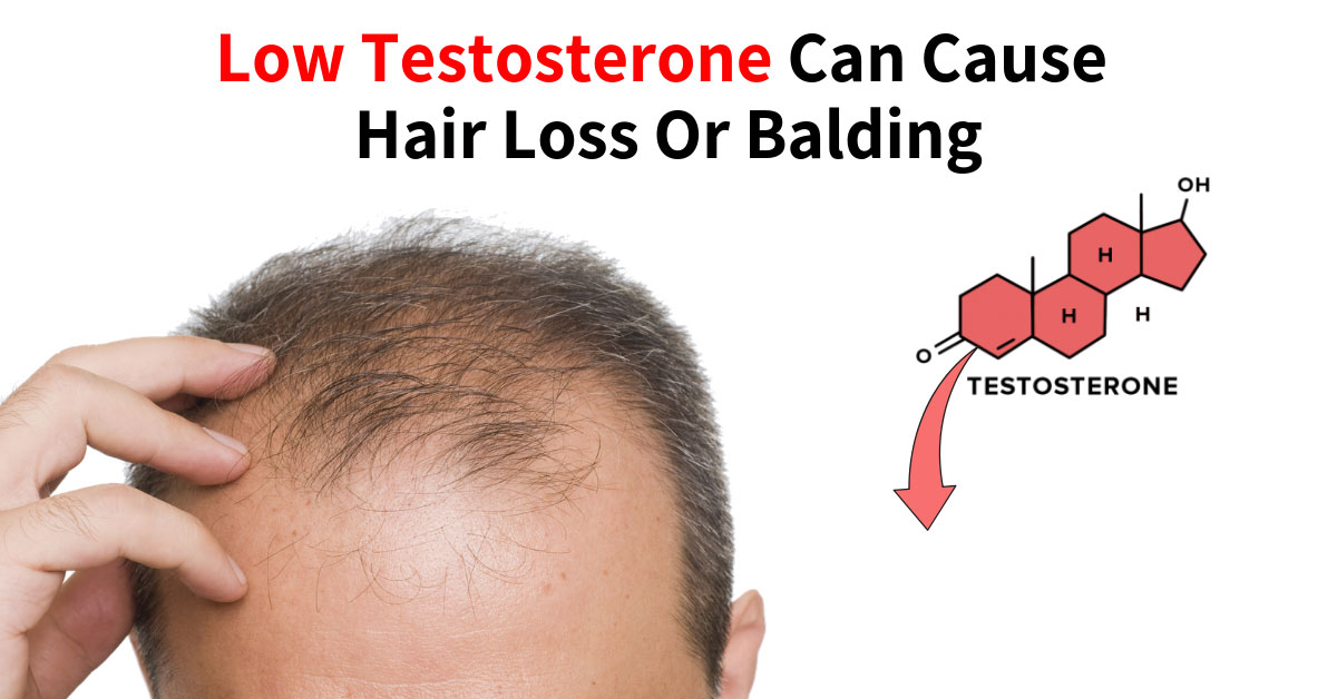 Low Testosterone Can Cause Hair Loss Or Balding Hair Loss Part 2 Dr Sam Robbins
