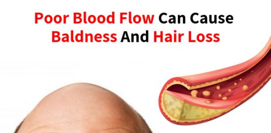 Poor Blood Flow Can Cause Baldness and Hair Loss