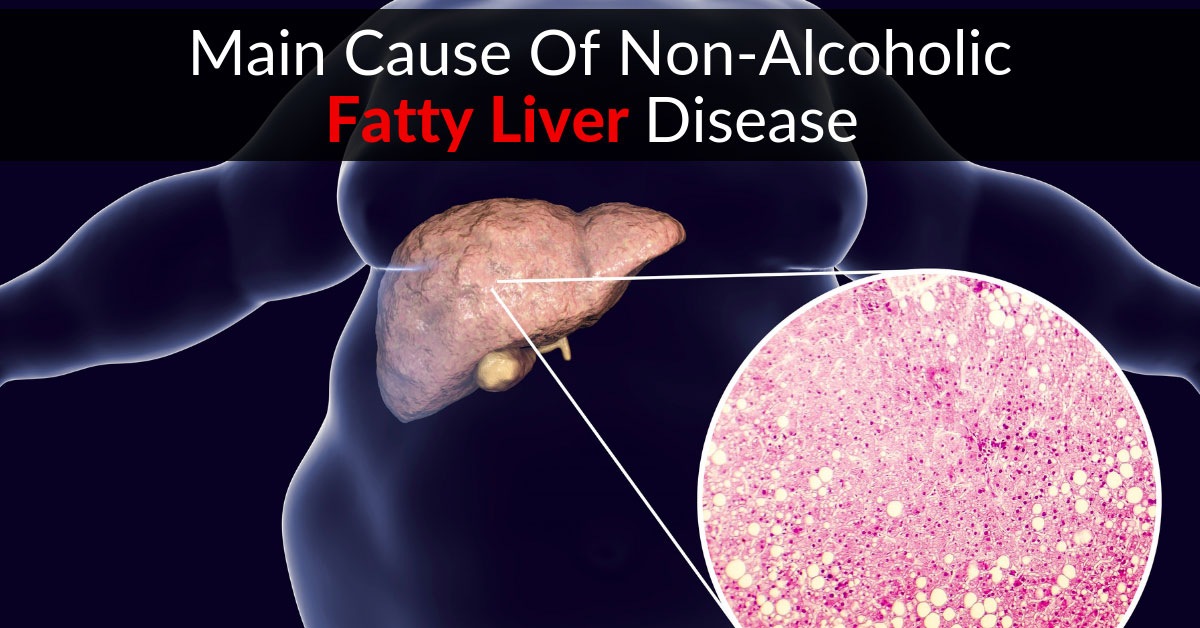 Non-Alcoholic Fatty Liver Disease (NAFLD) - The Main Cause