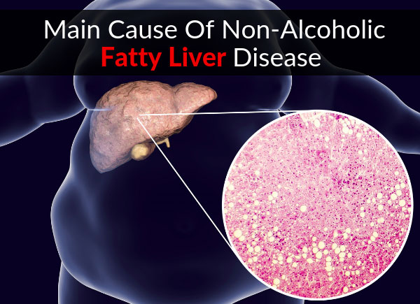 Main Cause Of Non-Alcoholic Fatty Liver Disease (NAFLD)