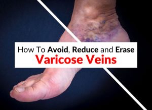 How To Avoid, Reduce and Erase Varicose Veins