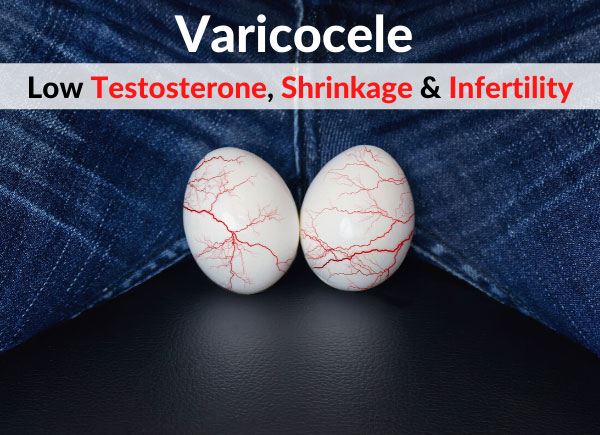 Varicocele (Scrotum Varicose Veins) - Low Testosterone, Testicular Shrinkage & Infertility