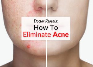 Doctor Reveals How To Eliminate Acne, Zits & Pimples From Face & Body