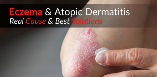 Eczema & Atopic Dermatitis – Real Cause & Best Solutions
