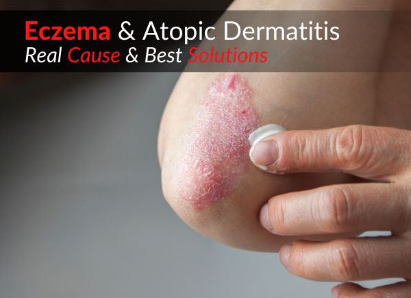 Eczema & Atopic Dermatitis – Real Cause & Best Solutions