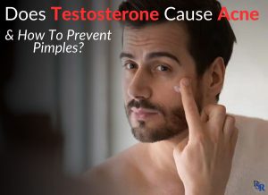 Does Testosterone Cause Acne & How To Prevent Pimples?